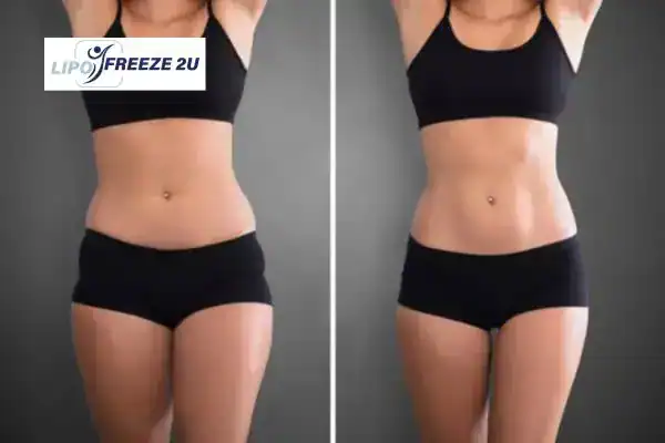 How Can LIPO FREEZE 2U Support Your Post-Pregnancy Body Recovery Kingsbury?