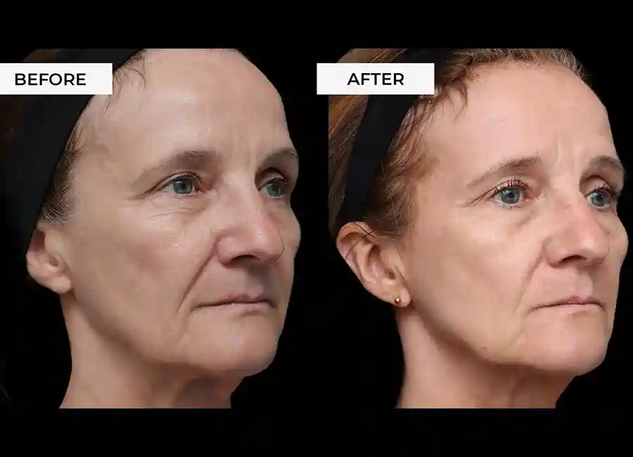 How Many RF Microneedling Sessions Will You Need to See a Difference Kingsbury?