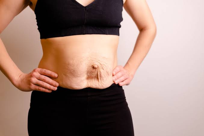 Is Surgery Really the Only Way to Repair Diastasis Recti Kingsbury?