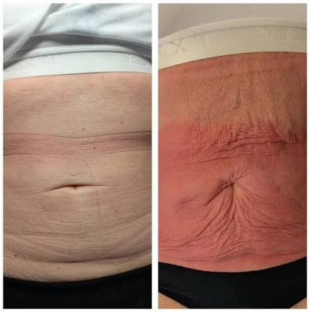 How Does RF Microneedling Improve Crepey, Thin and Uneven Skin Texture Kingsbury?
