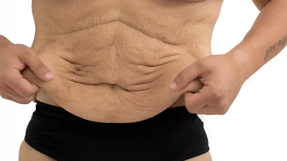 Why Does Weight Loss Medication Leave Some People With Loose or Sagging Skin Kingsbury?